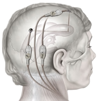 Living with Hydrocephalus for most means the implanting of a CNS Shunt as Illustrated here.